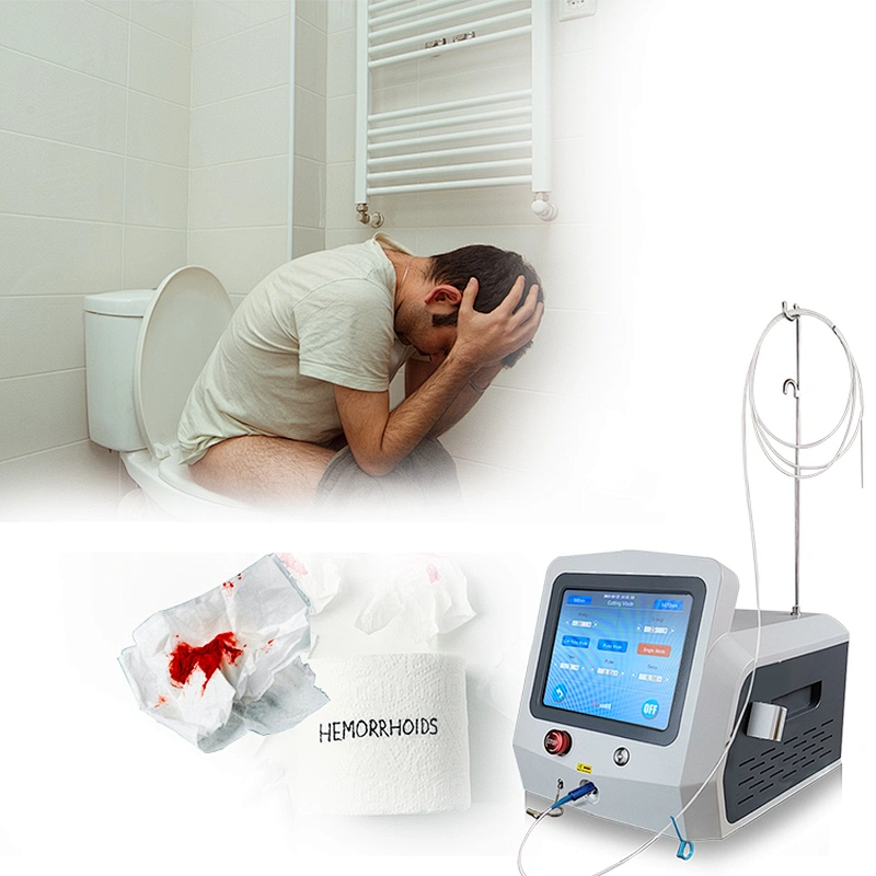 Effective diode laser hemorrhoids treatment
